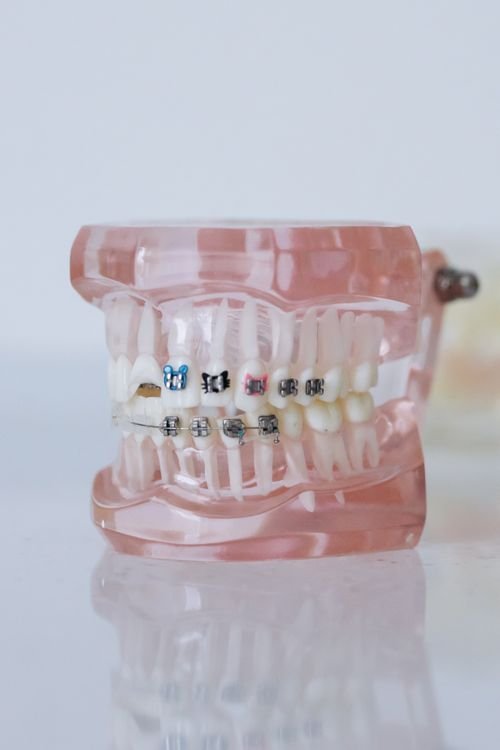 Emergency dental clinic in Toronto explaining how to handle a broken tooth at home